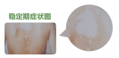 宁波最好的白癜风专科医院